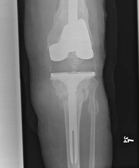 Periprosthetic TKR Tibial Fracture 4